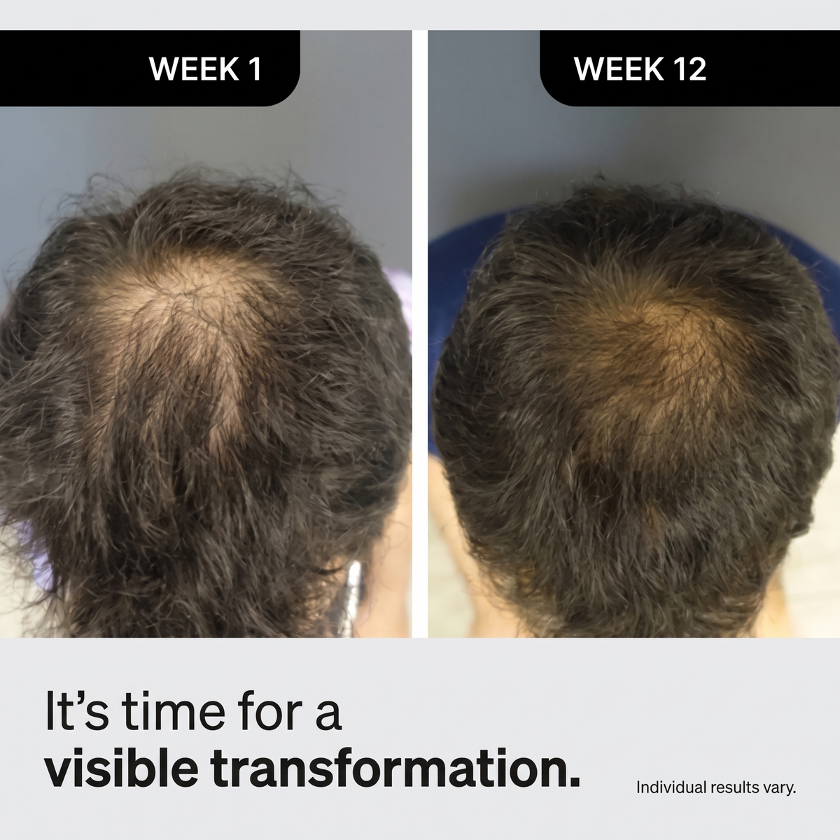 Tenure Hair Regrowth System